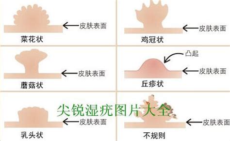 女生陰毛癢|陰毛瘙癢及皮膚變化原因解析